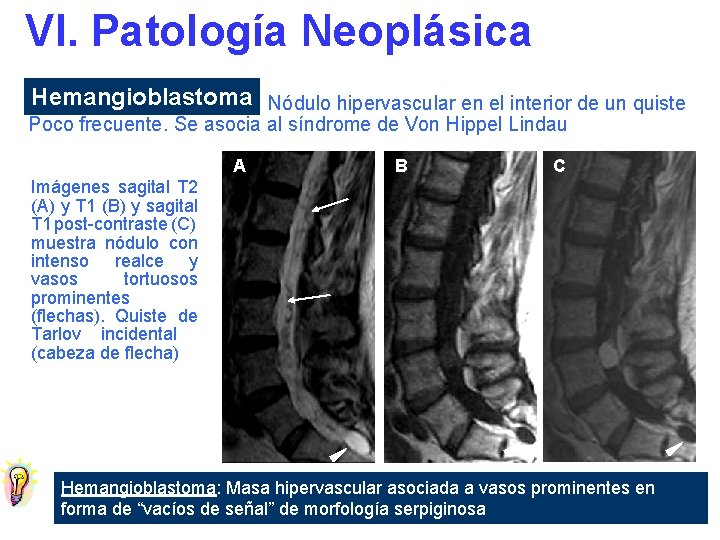 VI. Patología Neoplásica Hemangioblastoma Nódulo hipervascular en el interior de un quiste Poco frecuente.