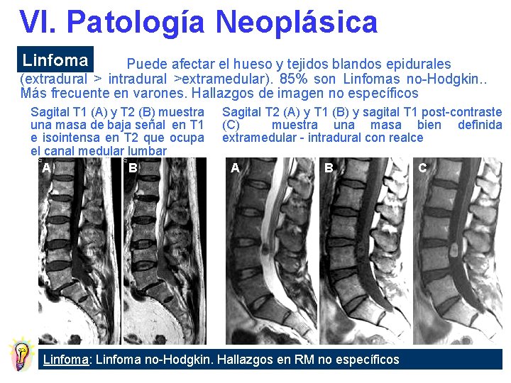 VI. Patología Neoplásica Linfoma Puede afectar el hueso y tejidos blandos epidurales (extradural >
