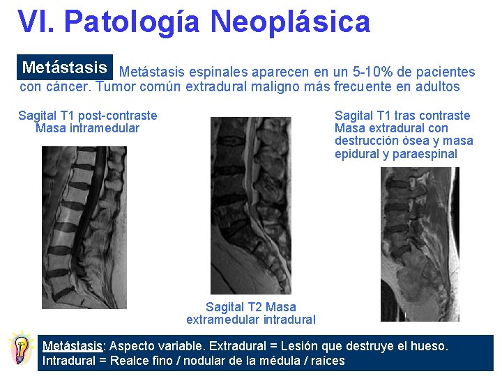 VI. Patología Neoplásica Metástasis espinales aparecen en un 5 -10% de pacientes con cáncer.