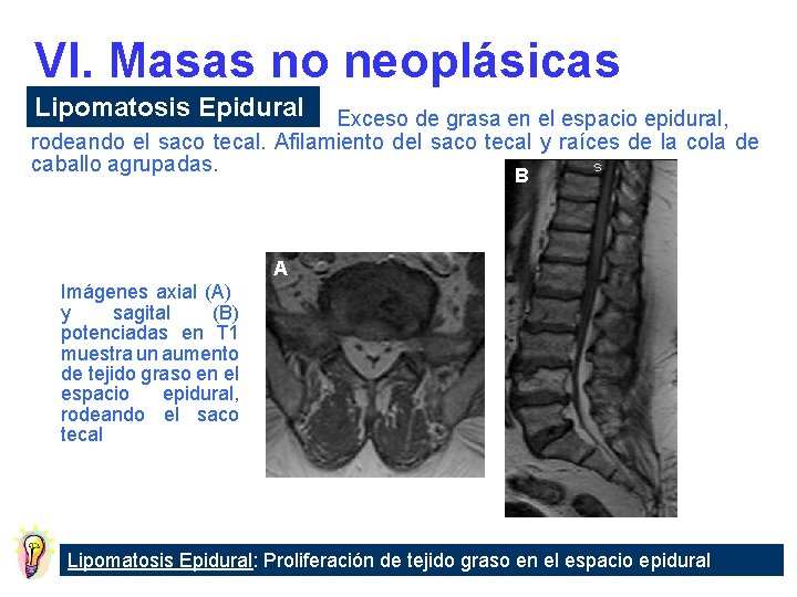 VI. Masas no neoplásicas Lipomatosis Epidural Exceso de grasa en el espacio epidural, rodeando