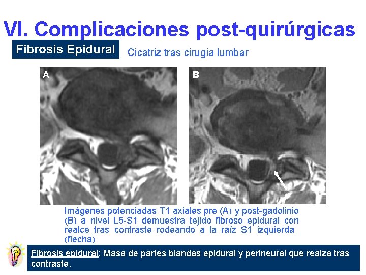 VI. Complicaciones post-quirúrgicas Fibrosis Epidural Cicatriz tras cirugía lumbar A B Imágenes potenciadas T
