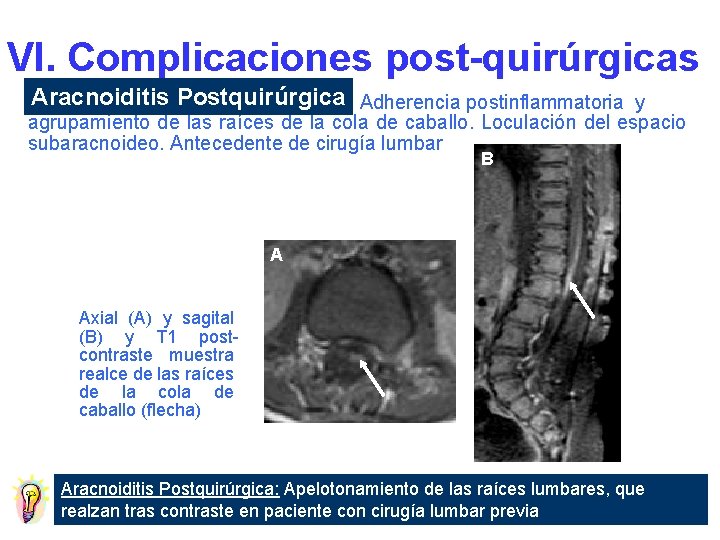 VI. Complicaciones post-quirúrgicas Aracnoiditis Postquirúrgica Adherencia postinflammatoria y agrupamiento de las raíces de la