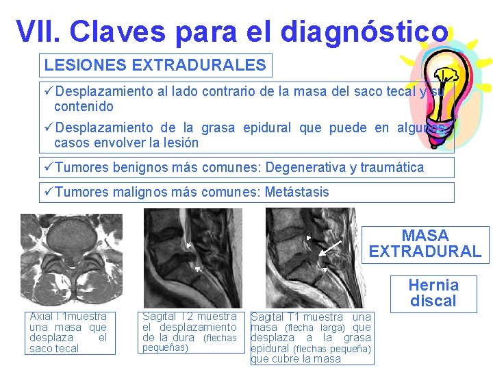 VII. Claves para el diagnóstico LESIONES EXTRADURALES üDesplazamiento al lado contrario de la masa
