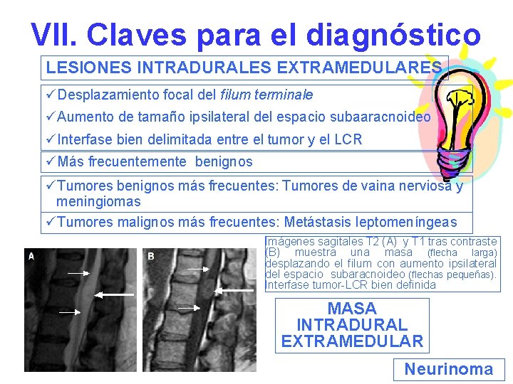 VII. Claves para el diagnóstico LESIONES INTRADURALES EXTRAMEDULARES üDesplazamiento focal del filum terminale üAumento
