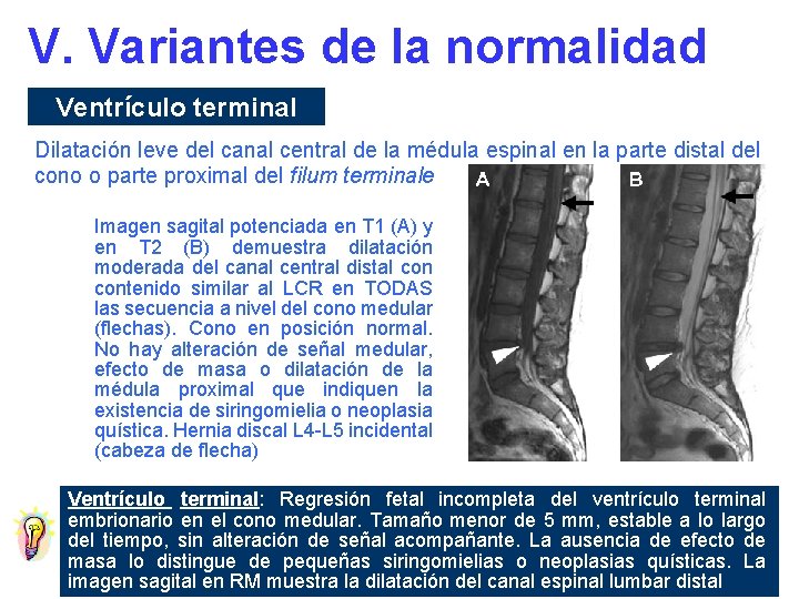 V. Variantes de la normalidad Ventrículo terminal Dilatación leve del canal central de la