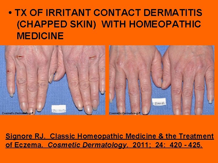  • TX OF IRRITANT CONTACT DERMATITIS (CHAPPED SKIN) WITH HOMEOPATHIC MEDICINE Cosmetic Dermatology©