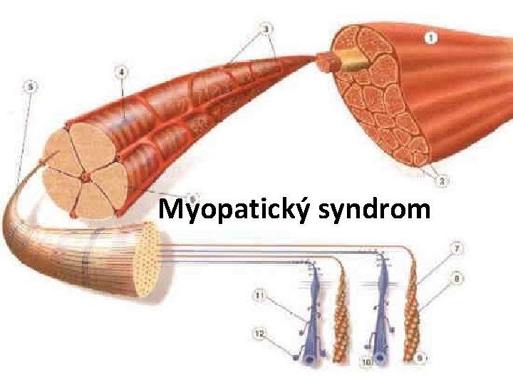Myopatický syndrom 