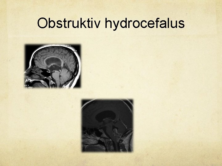 Obstruktiv hydrocefalus 