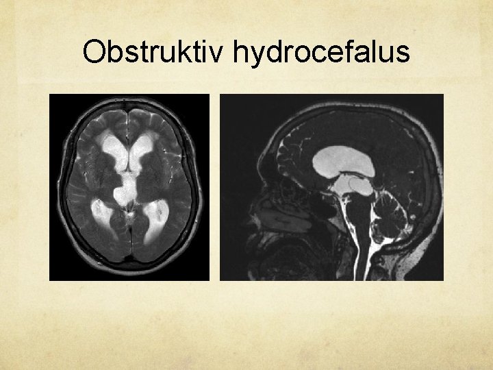 Obstruktiv hydrocefalus 