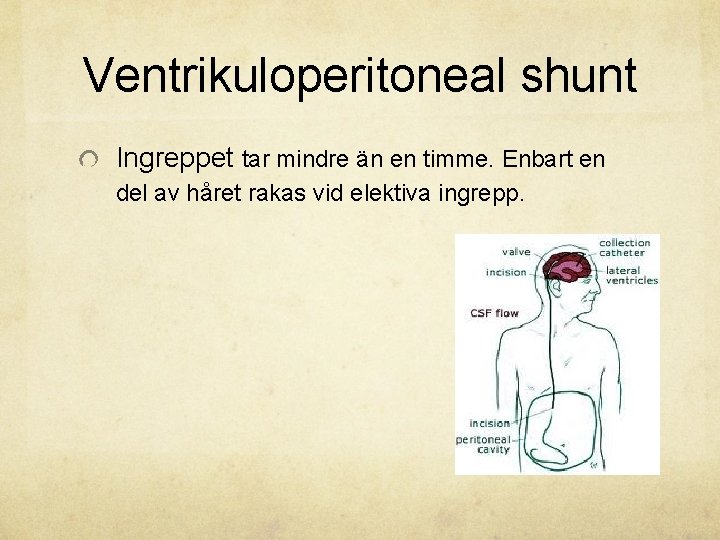 Ventrikuloperitoneal shunt Ingreppet tar mindre än en timme. Enbart en del av håret rakas