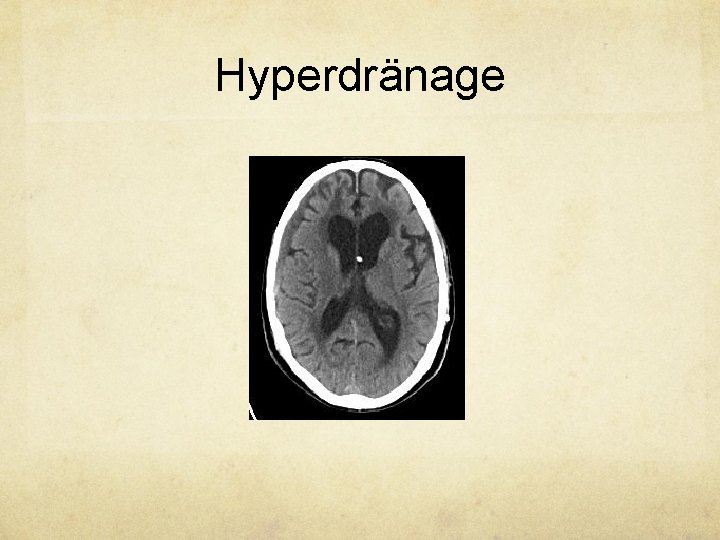 Hyperdränage 