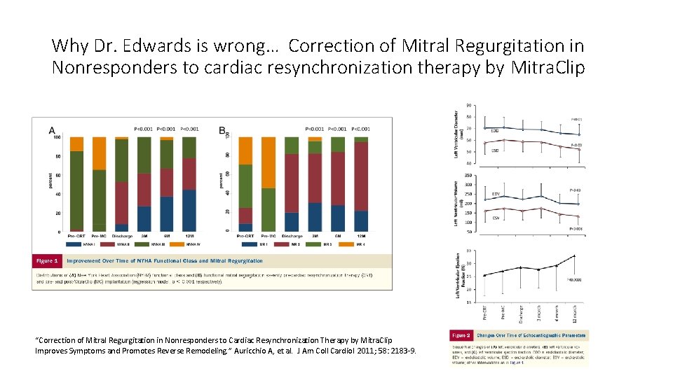 Why Dr. Edwards is wrong… Correction of Mitral Regurgitation in Nonresponders to cardiac resynchronization
