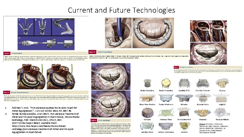 Current and Future Technologies 1. 2. Feldman T, et al. “Percutaneous approaches to valve