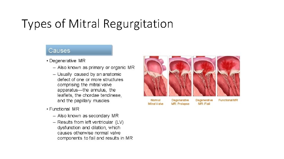 Types of Mitral Regurgitation 