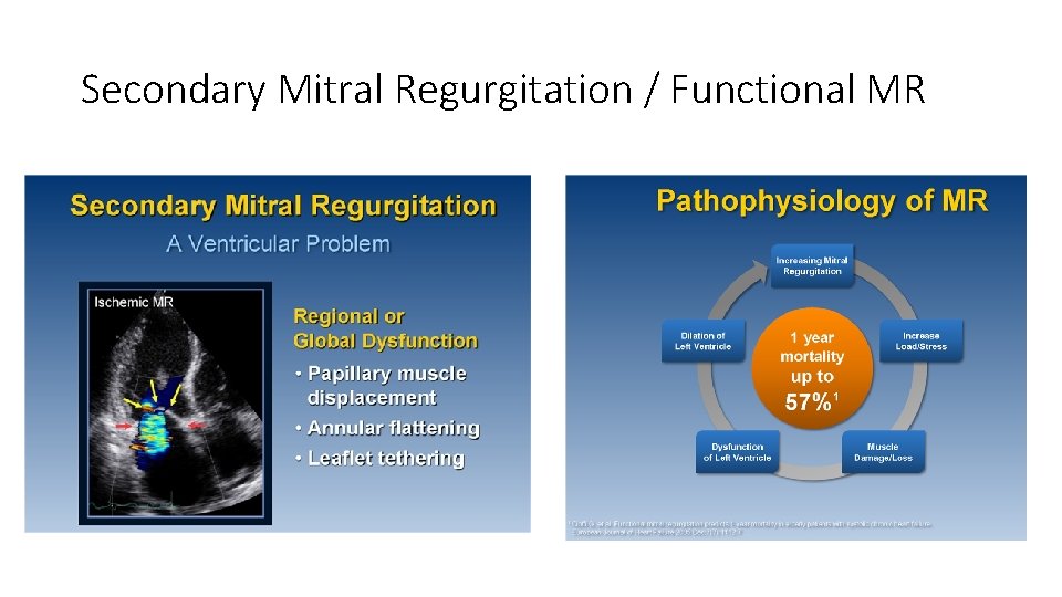 Secondary Mitral Regurgitation / Functional MR 