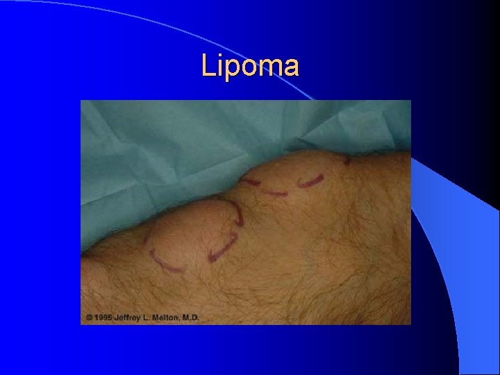 Lipoma 