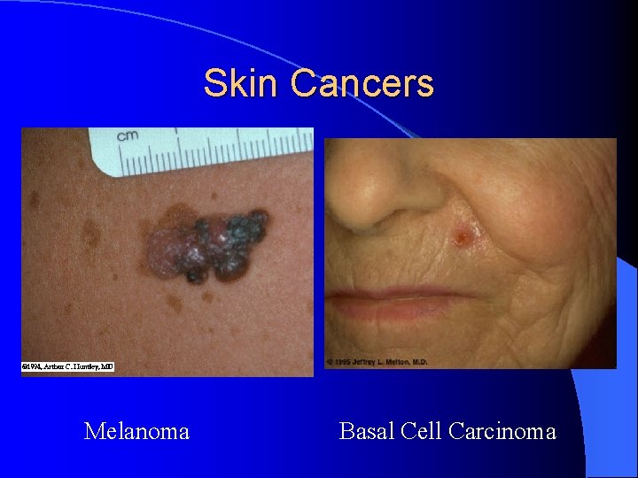 Skin Cancers Melanoma Basal Cell Carcinoma 
