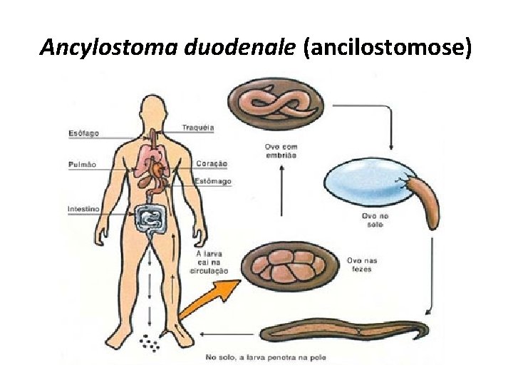 Ancylostoma duodenale (ancilostomose) 