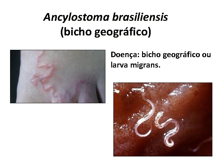 Ancylostoma brasiliensis (bicho geográfico) Doença: bicho geográfico ou larva migrans. 