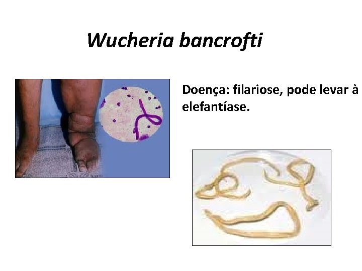 Wucheria bancrofti Doença: filariose, pode levar à elefantíase. 