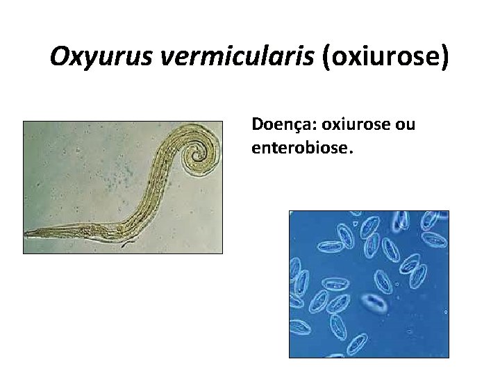 Oxyurus vermicularis (oxiurose) Doença: oxiurose ou enterobiose. 