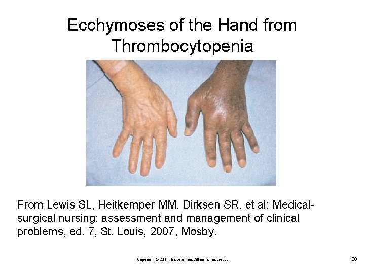 Ecchymoses of the Hand from Thrombocytopenia From Lewis SL, Heitkemper MM, Dirksen SR, et