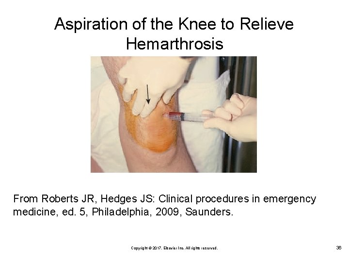 Aspiration of the Knee to Relieve Hemarthrosis From Roberts JR, Hedges JS: Clinical procedures