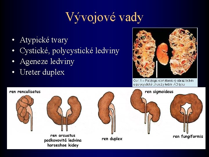 Vývojové vady • • Atypické tvary Cystické, polycystické ledviny Ageneze ledviny Ureter duplex 