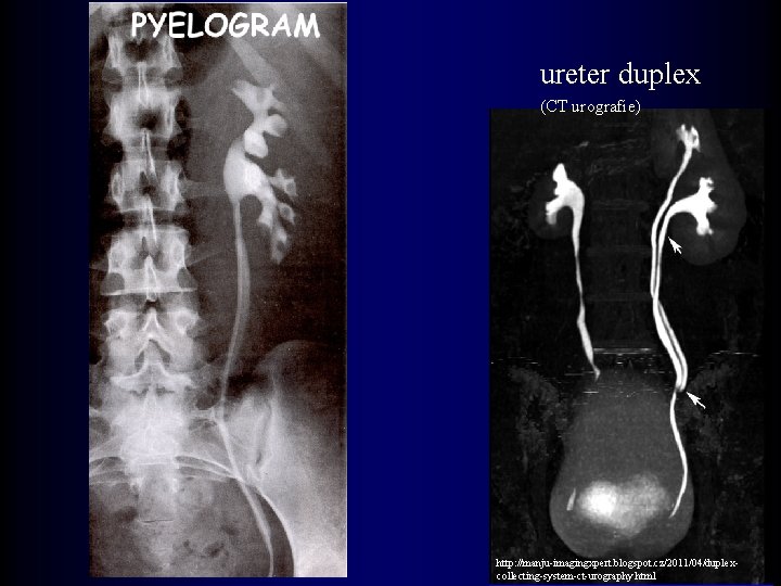 ureter duplex (CT urografie) http: //manju-imagingxpert. blogspot. cz/2011/04/duplexcollecting-system-ct-urography. html 