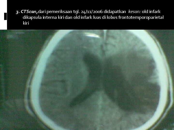 3. CTScan, dari pemeriksaan tgl. 24/11/2006 didapatkan kesan: old infark dikapsula interna kiri dan