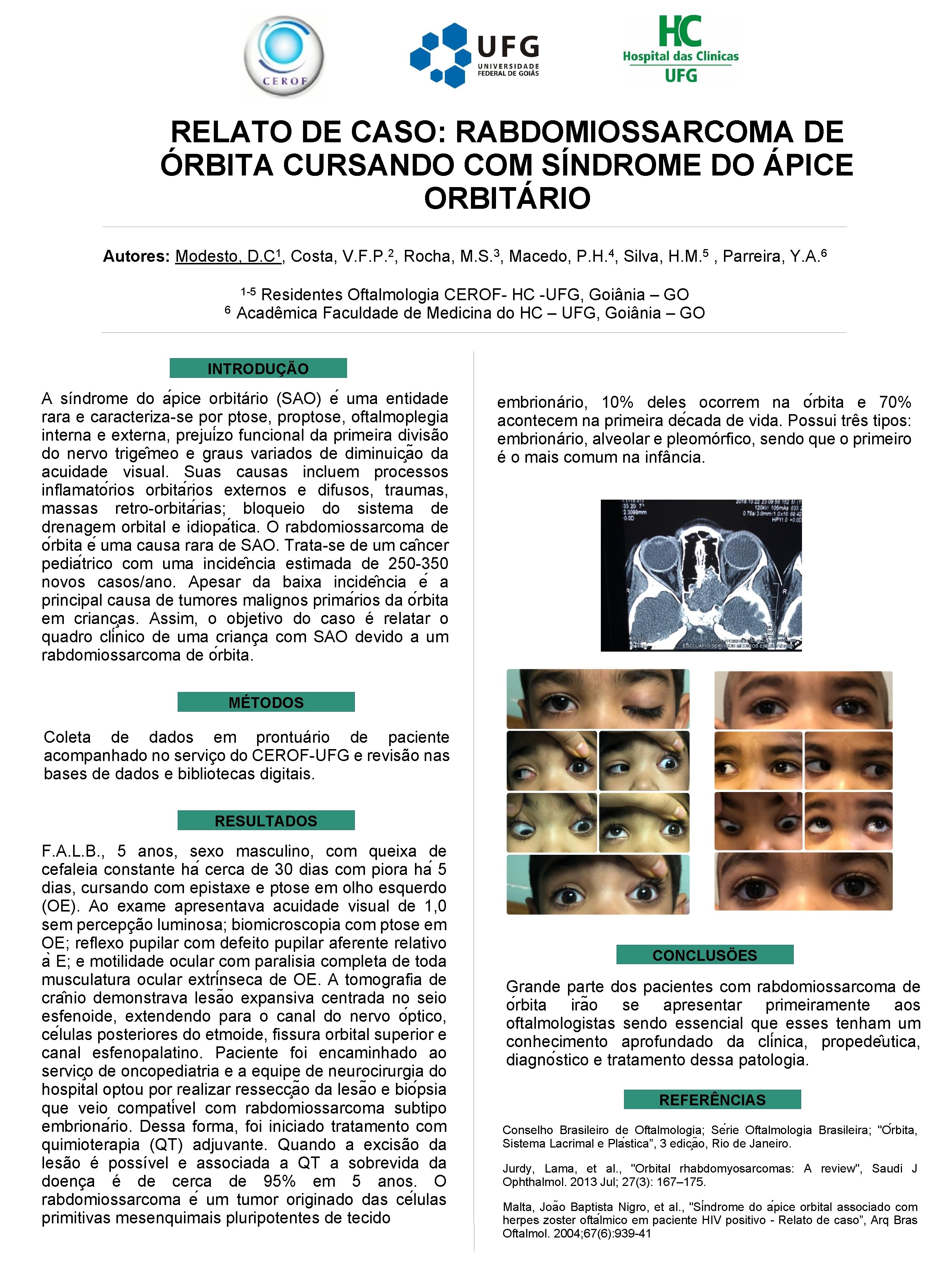 RELATO DE CASO: RABDOMIOSSARCOMA DE ÓRBITA CURSANDO COM SÍNDROME DO ÁPICE ORBITÁRIO Autores: Modesto,