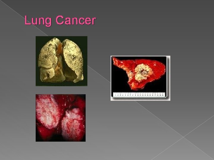 Lung Cancer 