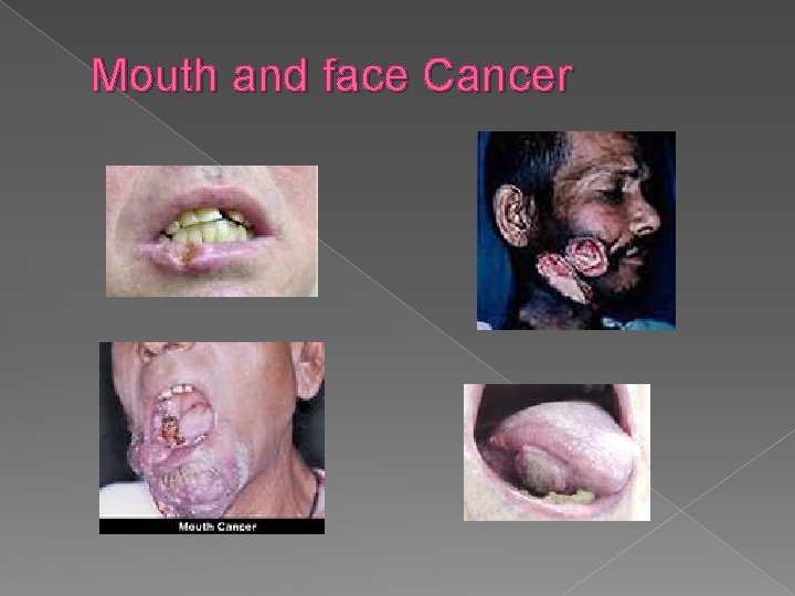 Mouth and face Cancer 