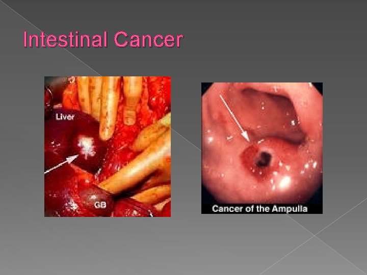 Intestinal Cancer 