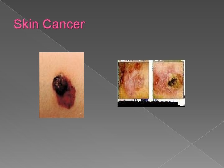 Skin Cancer 