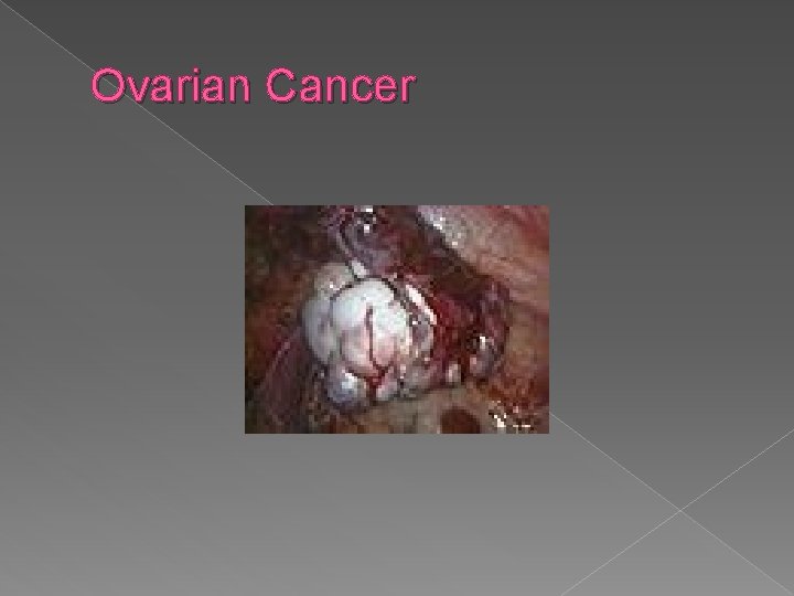 Ovarian Cancer 