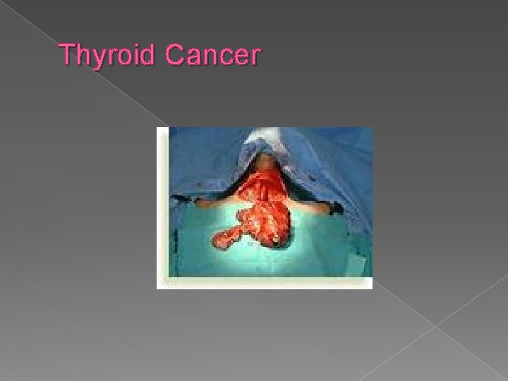 Thyroid Cancer 