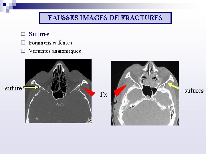 FAUSSES IMAGES DE FRACTURES q Sutures q Foramens et fentes q Variantes anatomiques suture