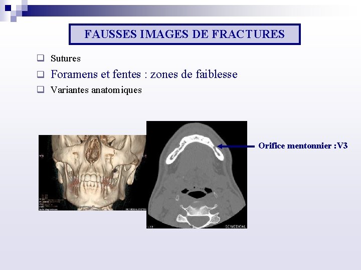 FAUSSES IMAGES DE FRACTURES q Sutures q Foramens et fentes : zones de faiblesse