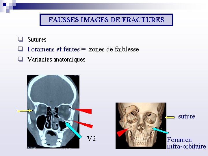 FAUSSES IMAGES DE FRACTURES q Sutures q Foramens et fentes = zones de faiblesse