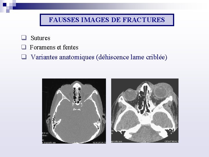 FAUSSES IMAGES DE FRACTURES q Sutures q Foramens et fentes q Variantes anatomiques (déhiscence