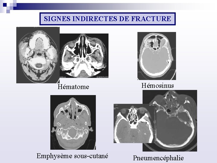 SIGNES INDIRECTES DE FRACTURE Hématome Hémosinus Emphysème sous cutané Pneumencéphalie 