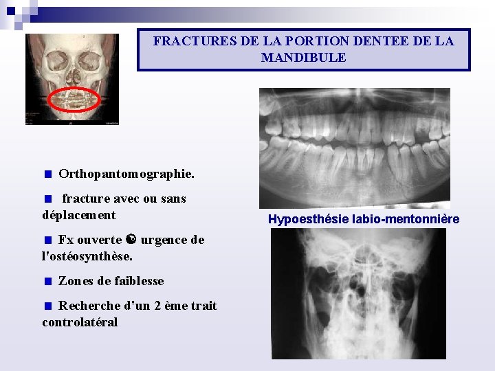 FRACTURES DE LA PORTION DENTEE DE LA MANDIBULE Orthopantomographie. fracture avec ou sans déplacement
