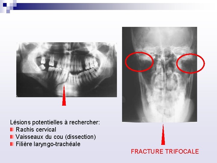 Lésions potentielles à recher: Rachis cervical Vaisseaux du cou (dissection) Filière laryngo trachéale FRACTURE