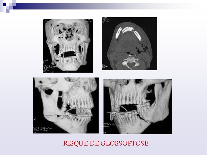 RISQUE DE GLOSSOPTOSE 