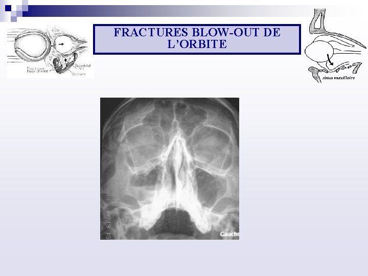 FRACTURES BLOW OUT DE L’ORBITE 