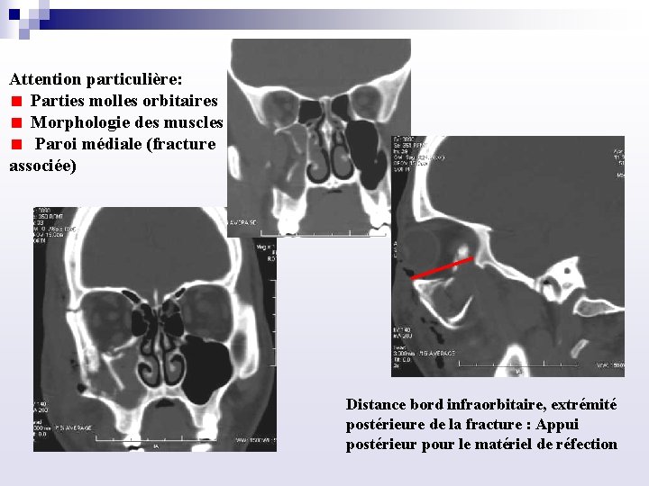 Attention particulière: Parties molles orbitaires Morphologie des muscles Paroi médiale (fracture associée) Distance bord