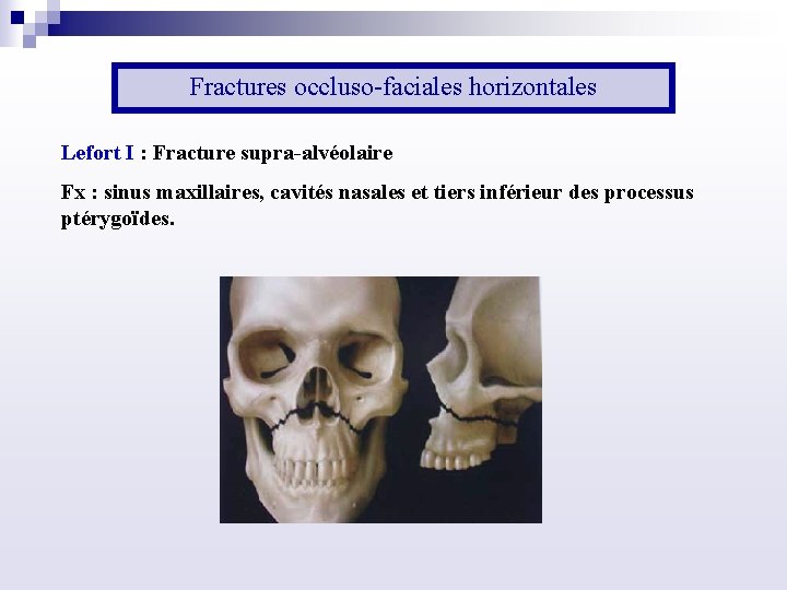 Fractures occluso faciales horizontales Lefort I : Fracture supra alvéolaire Fx : sinus maxillaires,