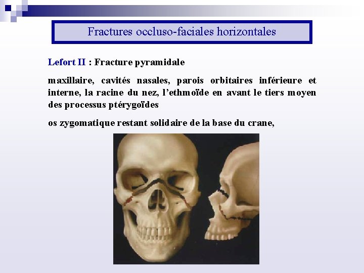 Fractures occluso faciales horizontales Lefort II : Fracture pyramidale maxillaire, cavités nasales, parois orbitaires
