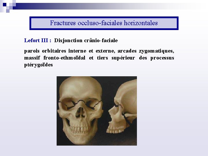 Fractures occluso faciales horizontales Lefort III : Disjonction crânio faciale parois orbitaires interne et